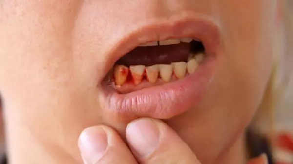 Mơ gãy răng chảy máu sắp tới sẽ có nhiều áp lực dành cho bạn